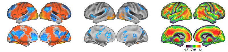amyloid